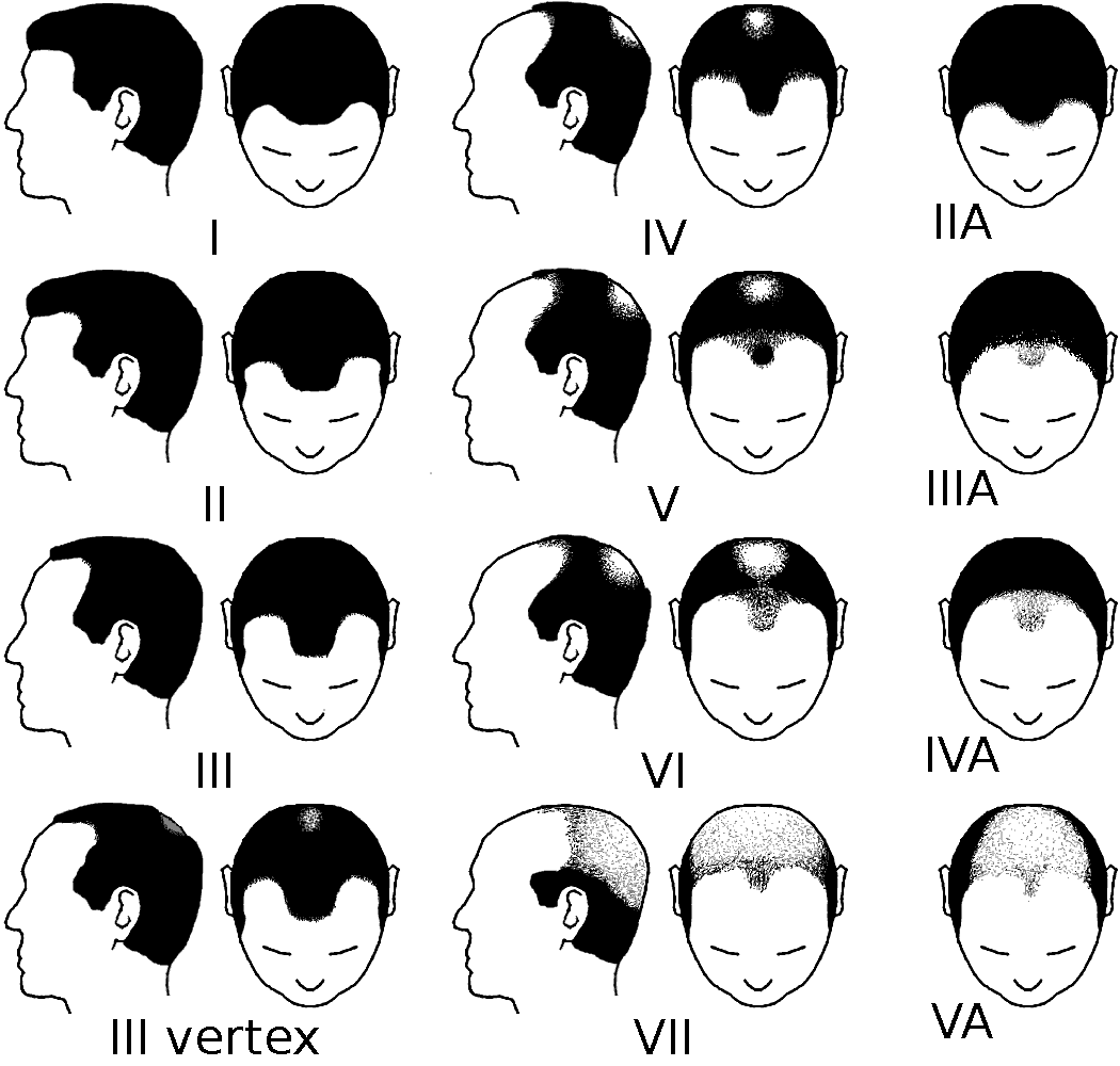 Norwood scale chart showing hair loss stages 1 to 7, 3 vertex and the A variants, each drawn as a side profile and a top view of the head